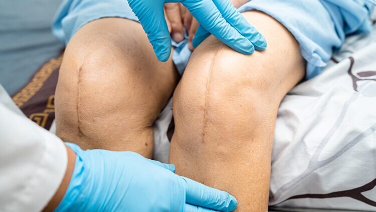 Break Up Scar Tissue To Heal Knee Replacement